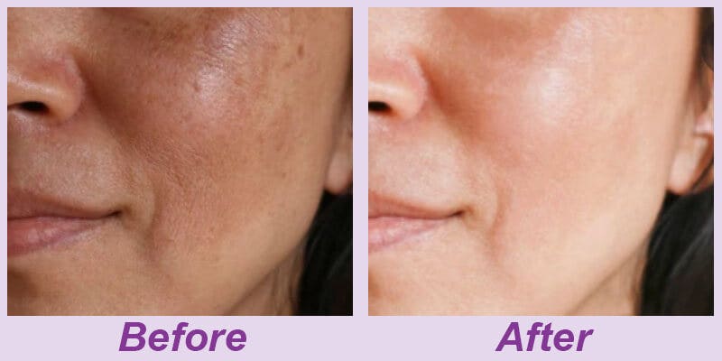 Before & After photos of skincare improvements using Hello Clear Skin Set